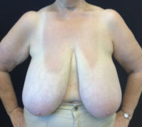 Breast Reduction