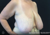 Breast Reduction