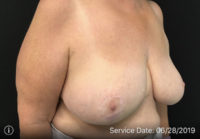 Breast Reduction