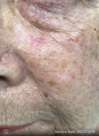 Squamous Cell Carcinoma