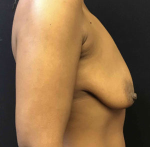 Breast Lift