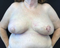 Breast Reconstruction