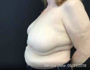 Breast Reconstruction