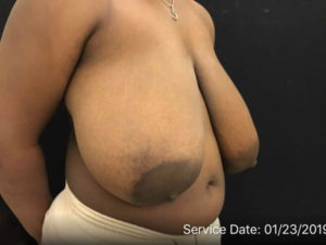 Breast Reduction