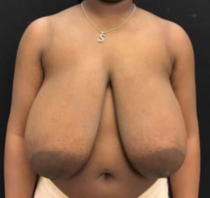 Breast Reduction