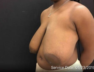 Breast Reduction