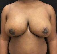 Breast Reduction