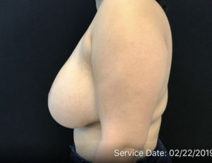 Breast Reduction