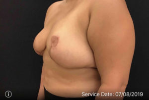 Breast Reduction