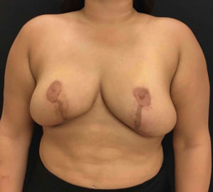 Breast Reduction