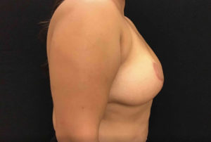 Breast Reduction