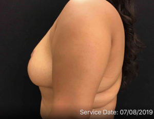 Breast Reduction