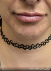 Lip Augmentation