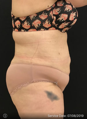 Liposuction