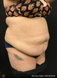 Liposuction