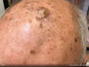 Squamous Cell Carcinoma