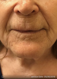 Upper Lip Lift