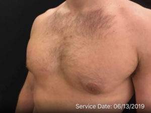 Gynecomastia