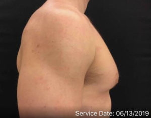 Gynecomastia