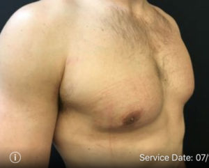 Gynecomastia