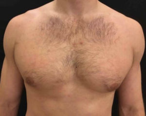 Gynecomastia