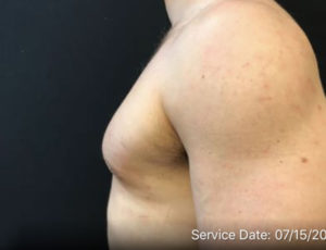 Gynecomastia