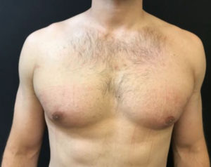 Gynecomastia