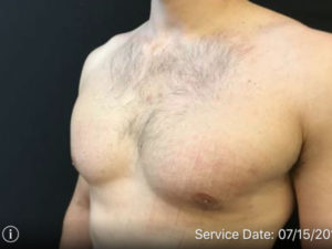 Gynecomastia