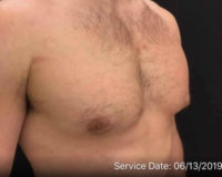 Gynecomastia