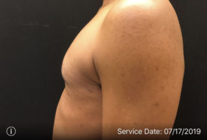 Gynecomastia