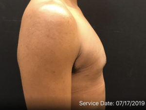 Gynecomastia