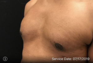 Gynecomastia