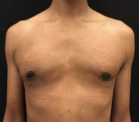 Gynecomastia