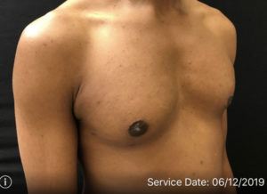 Gynecomastia