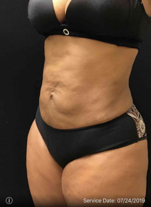 Liposuction