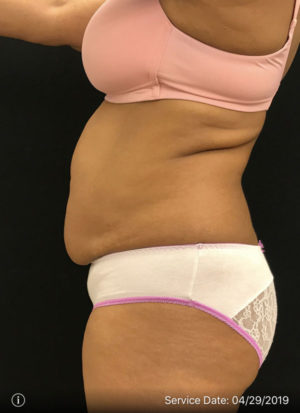 Liposuction