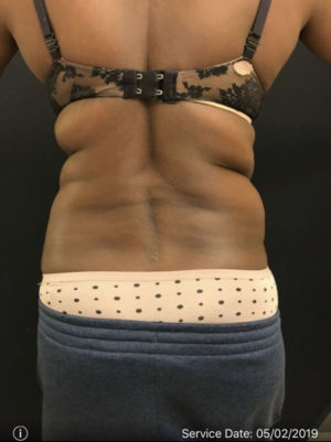 Liposuction