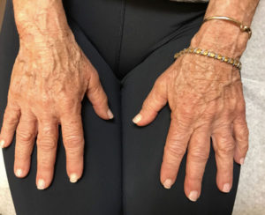 Hand Rejuvenation