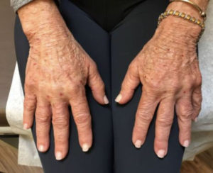 Hand Rejuvenation