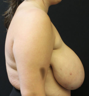 Breast Reduction