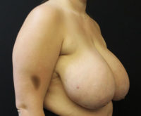 Breast Reduction