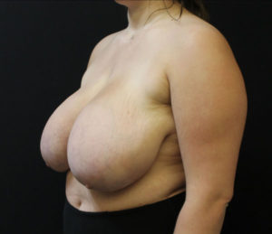 Breast Reduction