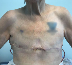 Breast Reconstruction