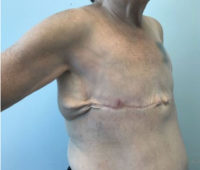 Breast Reconstruction