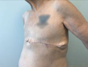 Breast Reconstruction