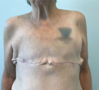 Breast Reconstruction