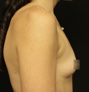 Breast Augmentation