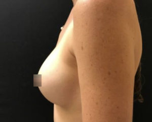 Breast Augmentation