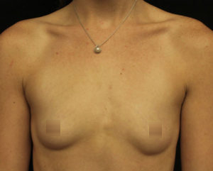 Breast Augmentation