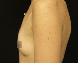 Breast Augmentation